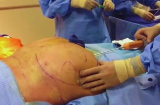 Woman Dies During BBL Procedure