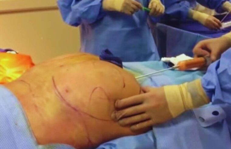 Woman Dies During BBL Procedure